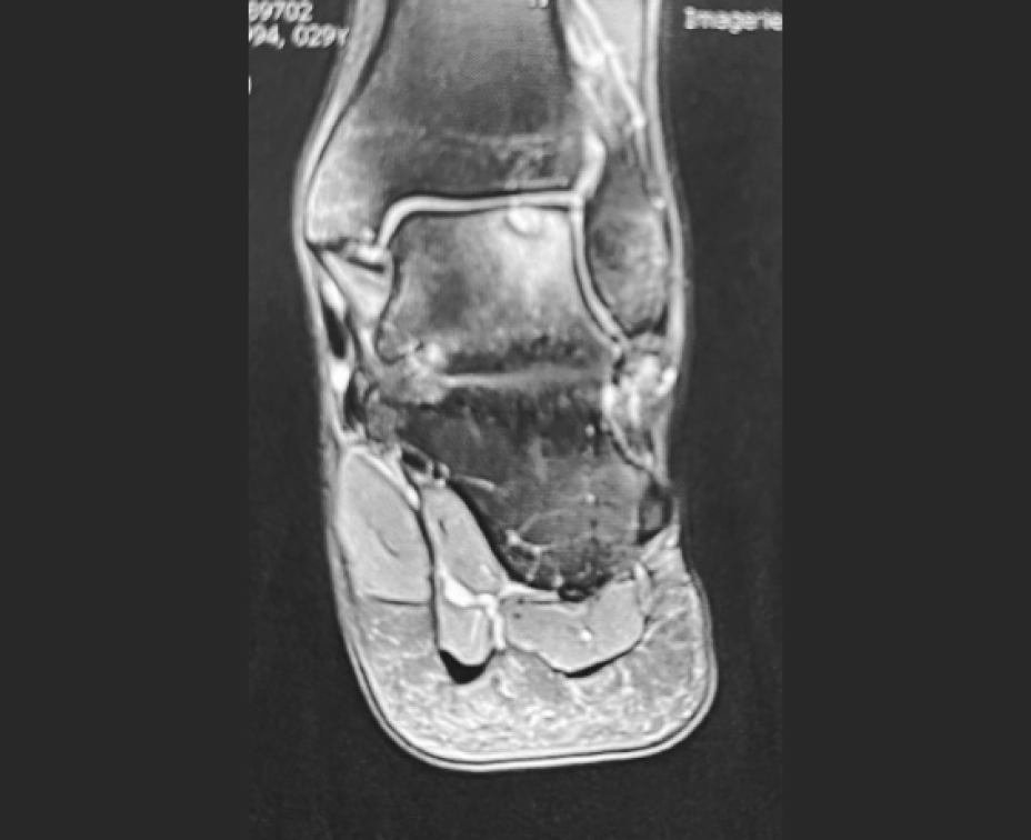 leziune osteocondrala